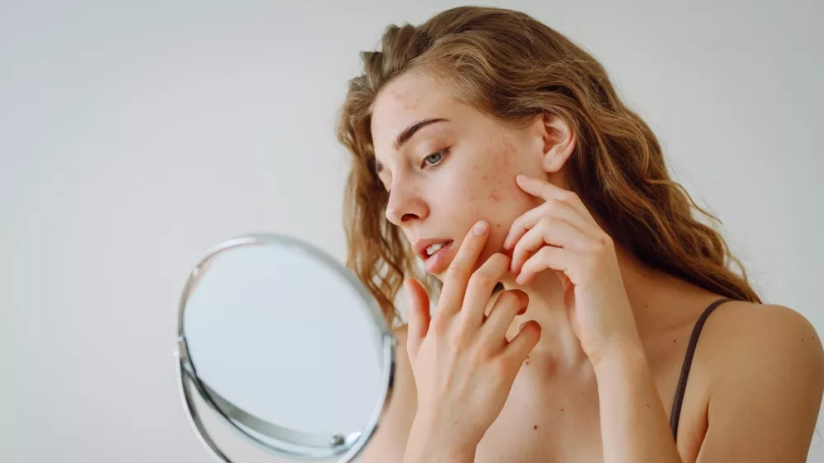 Ακμή ενηλίκων και διατροφικές διαταραχές: Έρευνα αποκαλύπτει μια επικίνδυνη σχέση