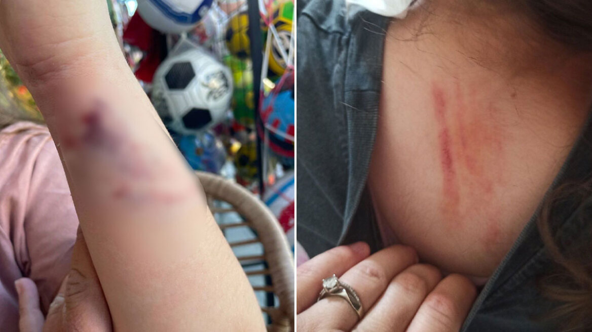 Πέλλα: Άγρια επίθεση από αδέσποτο σκύλο δέχτηκε μια 10χρονη - «Σώθηκε τελευταία στιγμή» λέει η μητέρα της