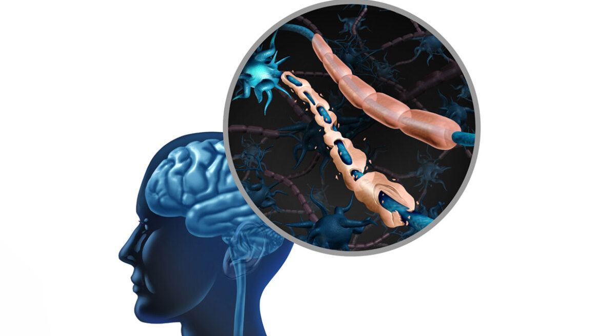 30 Μαΐου Παγκόσμια ημέρα για τη Σκλήρυνση Κατά Πλάκας