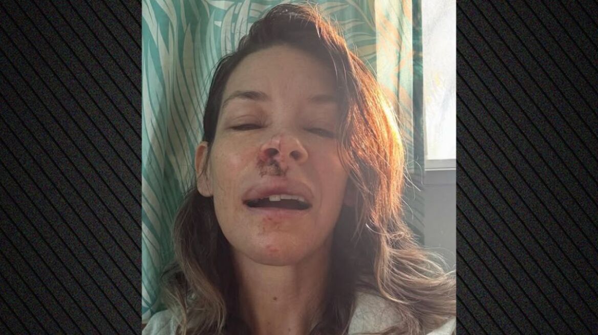 Η Εβάντζελιν Λίλι δημοσίευσε φωτογραφίες με τραύματα στο πρόσωπό της μετά από λιποθυμία και πτώση σε παραλία