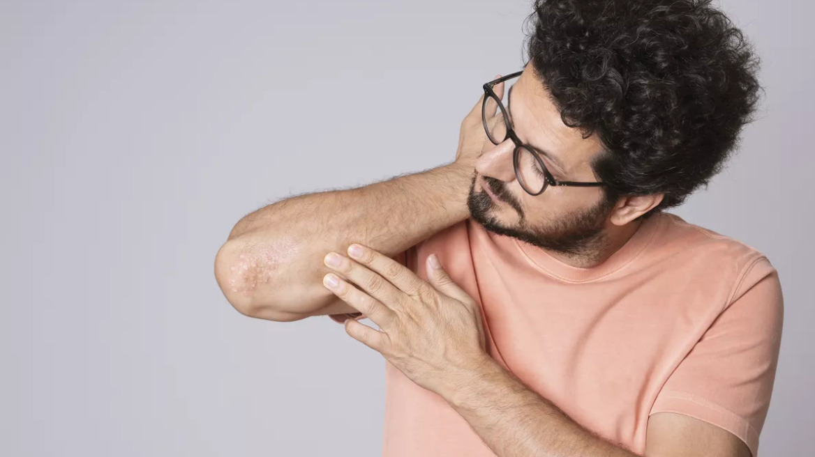 Ψωρίαση: Ανακαλύψτε τη βιταμίνη που αποτελεί φυσικό σύμμαχο για το δέρμα
