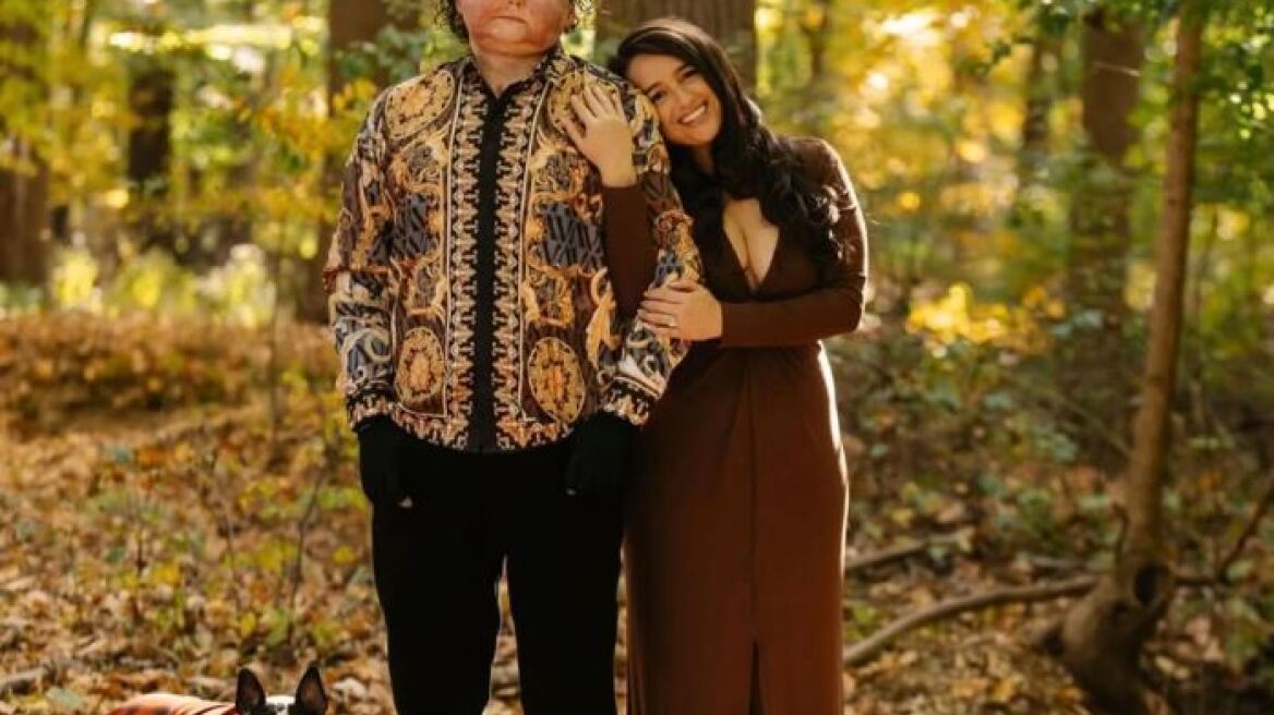 Κάηκε το 80% του δέρματός του σε ατύχημα: Βρήκε την αγάπη σε μια νοσηλεύτρια