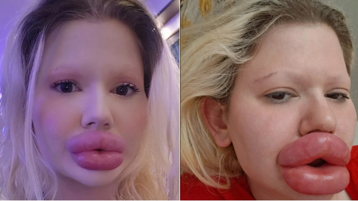 Η γυναίκα με τα μεγαλύτερα χείλη στον κόσμο: Οι γιατροί αρνιούνται να την αναλάβουν πια