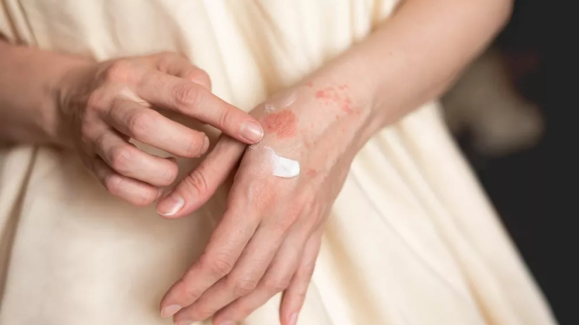 Χρόνιο έκζεμα: «Πράσινο φως» από τον FDA για την πρώτη θεραπευτική κρέμα χεριών
