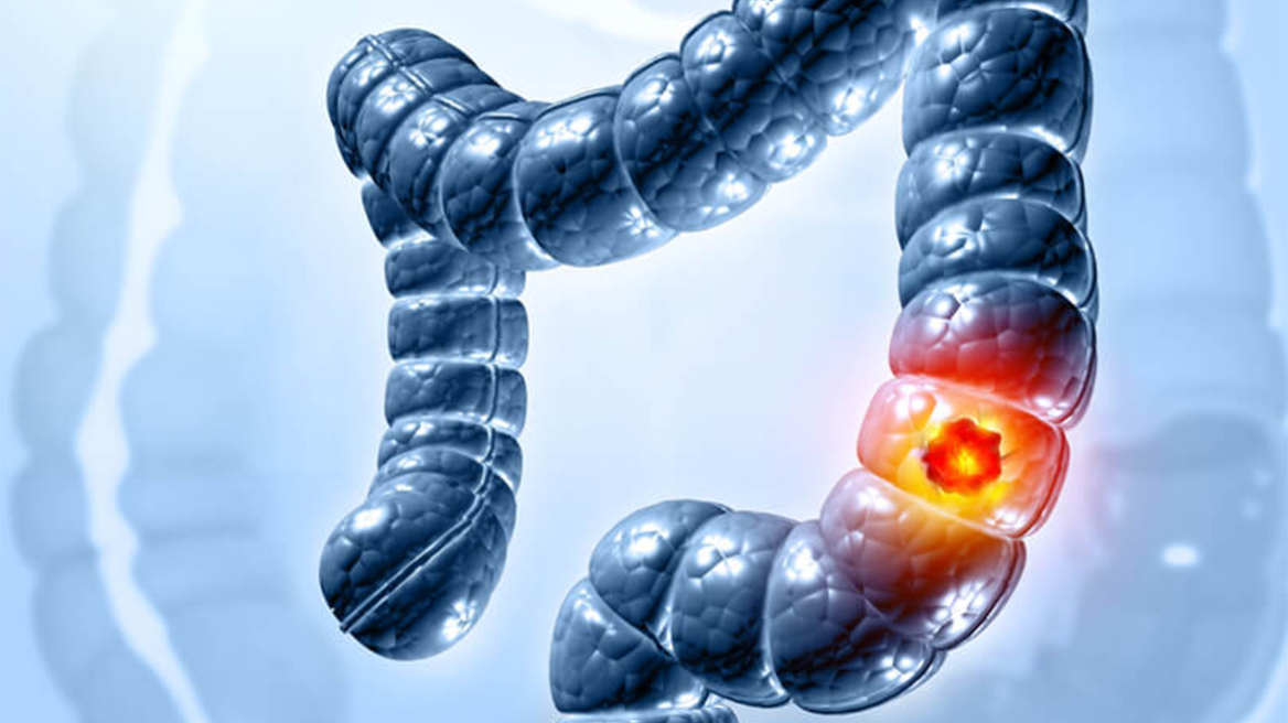 Καρκίνος του παχέος εντέρου: Ποια συμπτώματα προειδοποιούν;