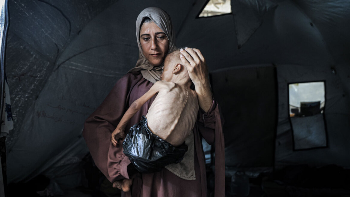 Οι New York Times διόρθωσαν την ιστορία του αποστεωμένου μικρού Μοχάμεντ από τη Γάζα: «Έχει και άλλη πάθηση»