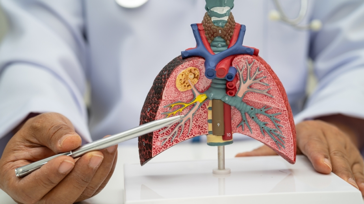 Καινοτόμος ανοσοθεραπεία κατά του καρκίνου του πνεύμονα, με ελληνική σφραγίδα