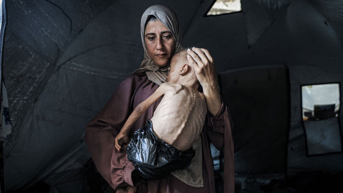 The Lancet: Σχεδόν το ένα παιδί στα έξι υφίσταται ακραίο οξύ υποσιτισμό στη Γάζα 
