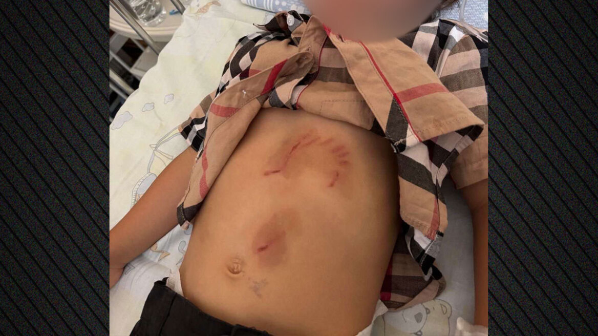 Εκδορές και δαγκώματα έχει το 5χρονο παιδί μετά την επίθεση από λύκο στη Χαλκιδική - Βίντεο δείχνει το ζώο να κυκλοφορεί ανενόχλητο στην παραλία