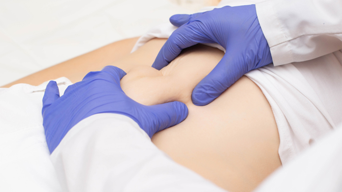 Βουβωνοκήλη: Συμπτώματα, κίνδυνοι και θεραπεία