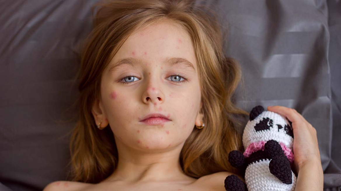 Έξαρση ιλαράς στην αμερικανική ήπειρο – Οι 3 χώρες με το 96% των κρουσμάτων
