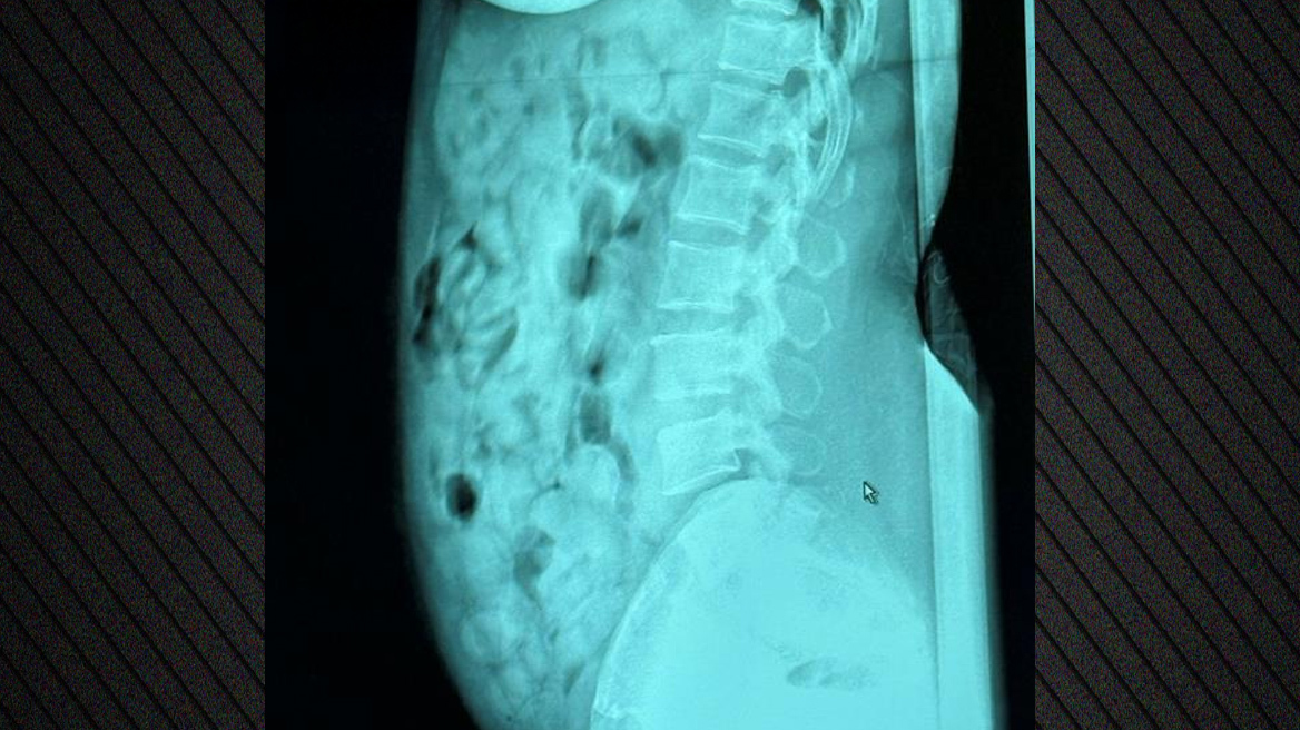Συνελήφθη 46χρονη στο Μπέργκαμο με 120 αμπούλες ηρωίνης στο στομάχι της - Δείτε φωτογραφία