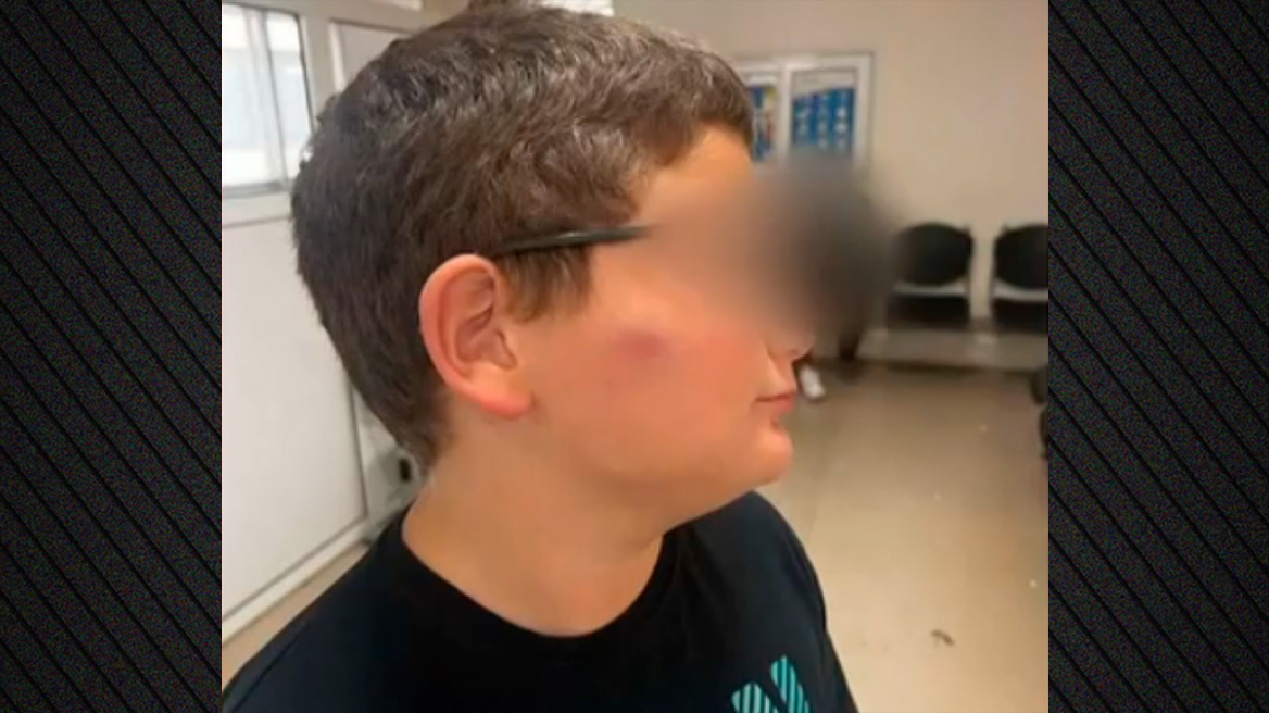 11χρονος ξυλοκοπήθηκε σε σχολείο στη Θεσσαλονίκη - «Η διευθύντρια μου είπε να του μάθω να μην δίνει σημασία στο bullying» καταγγέλλει η μητέρα του