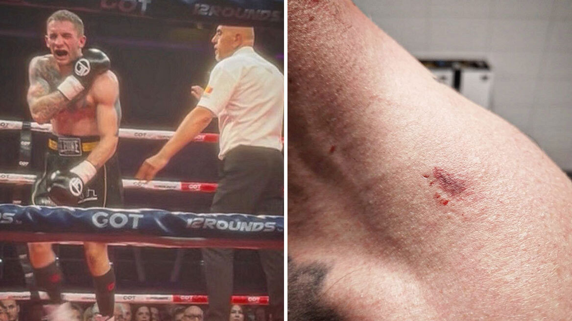 Αλβανός πυγμάχος δάγκωσε Σέρβο αντίπαλο του, αλλά κέρδισε τον αγώνα