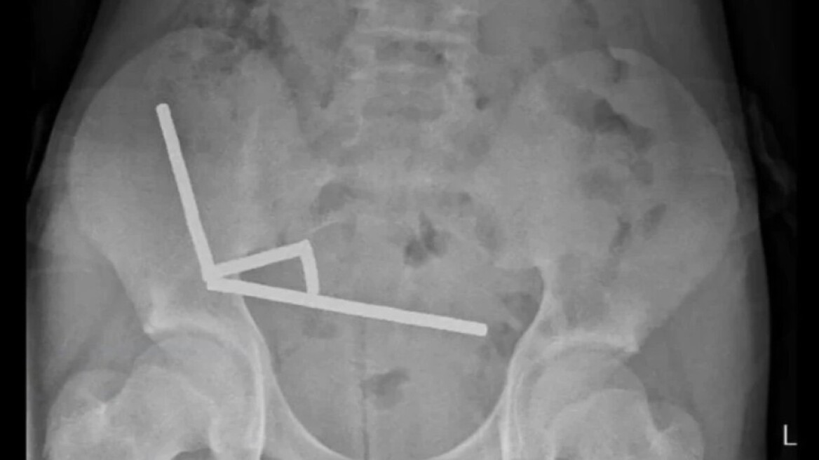 Δεκάδες μαγνήτες από τα έντερα 13χρονου αφαίρεσαν γιατροί στη Νέα Ζηλανδία
