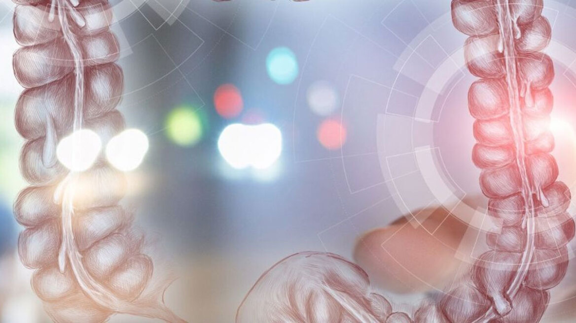 Εκκολπωμάτωση παχέος εντέρου: Παράγοντες κινδύνου και θεραπευτικές επιλογές
