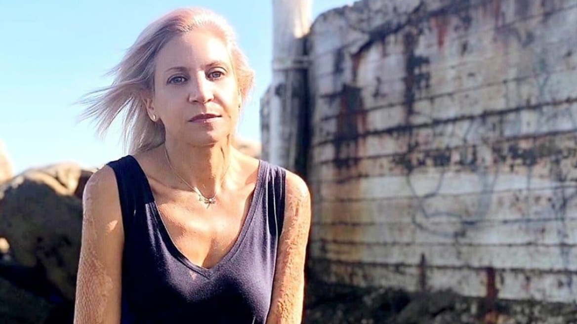 Κάλλι Αναγνώστου: Δεν γίνεται ακόμη να λέμε ότι δεν ξέραμε για νεκρούς ή για καμένους ανθρώπους, λέει για το βιβλίο Τσίπρα η εγκαυματίας από το Μάτι