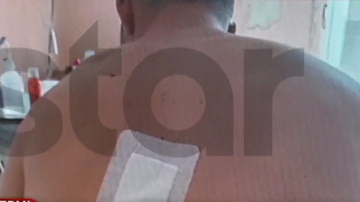 Τροχαίο με εγκατάλειψη στο Πικέρμι: «Πονάω αφόρητα, παραμορφώθηκα» λέει ο 22χρονος Άγγελος 