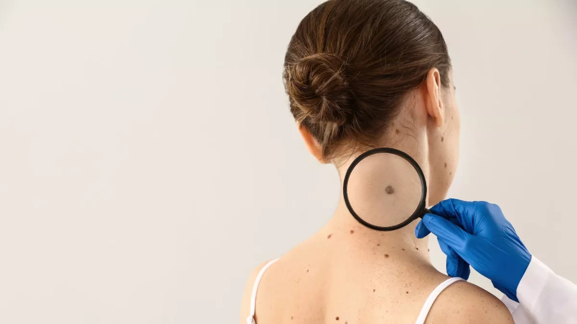 Μελάνωμα: Η συνδυαστική θεραπεία που μειώνει τον κίνδυνο υποτροπής ή θανάτου κατά 49%
