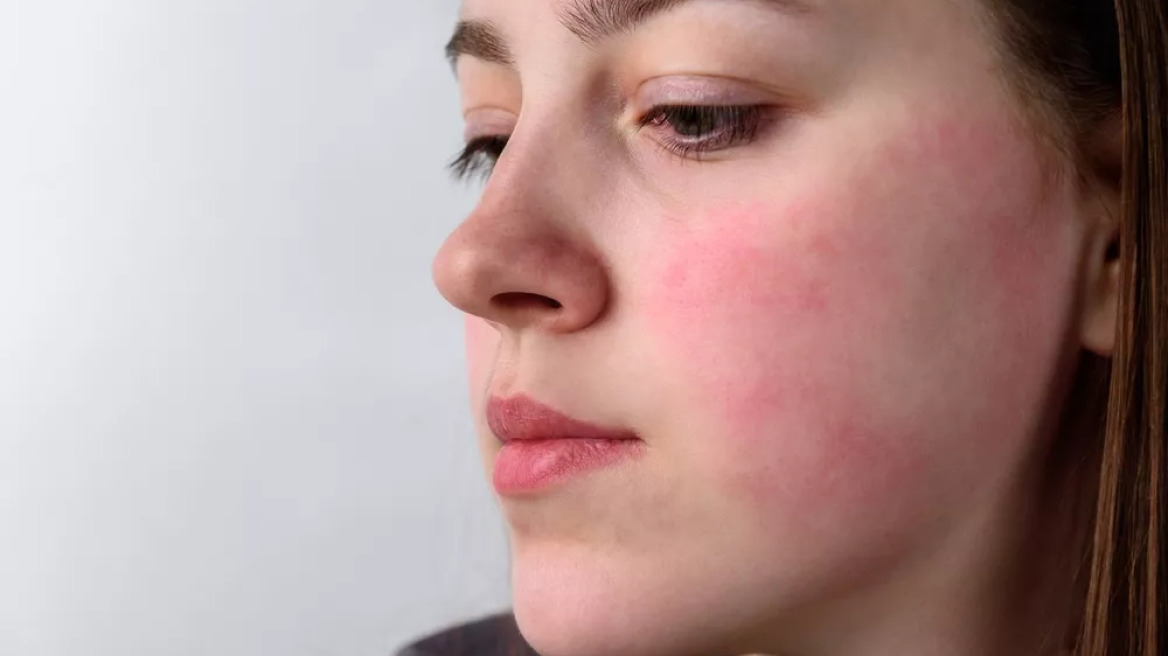 Δέρμα σε κατάσταση «συναγερμού» – Οι λύσεις που χαρίζουν ανακούφιση τον χειμώνα
