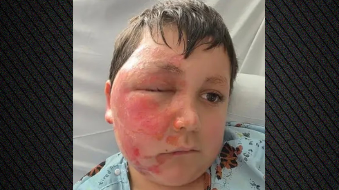 Σοβαρά εγκαύματα από φούρνο μικροκυμάτων υπέστη 9χρονος στο Ιλινόι για ένα trend στο Tik Tok: Δείτε βίντεο