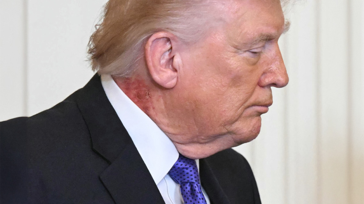 Εξάνθημα στον λαιμό του Τραμπ προκαλεί νέα ερωτήματα για την υγεία του, δείτε βίντεο