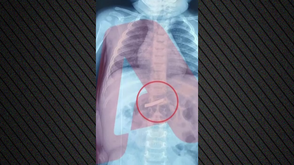 Τρίχρονος κατάπιε ξυράφι, χειρουργήθηκε στο Παίδων