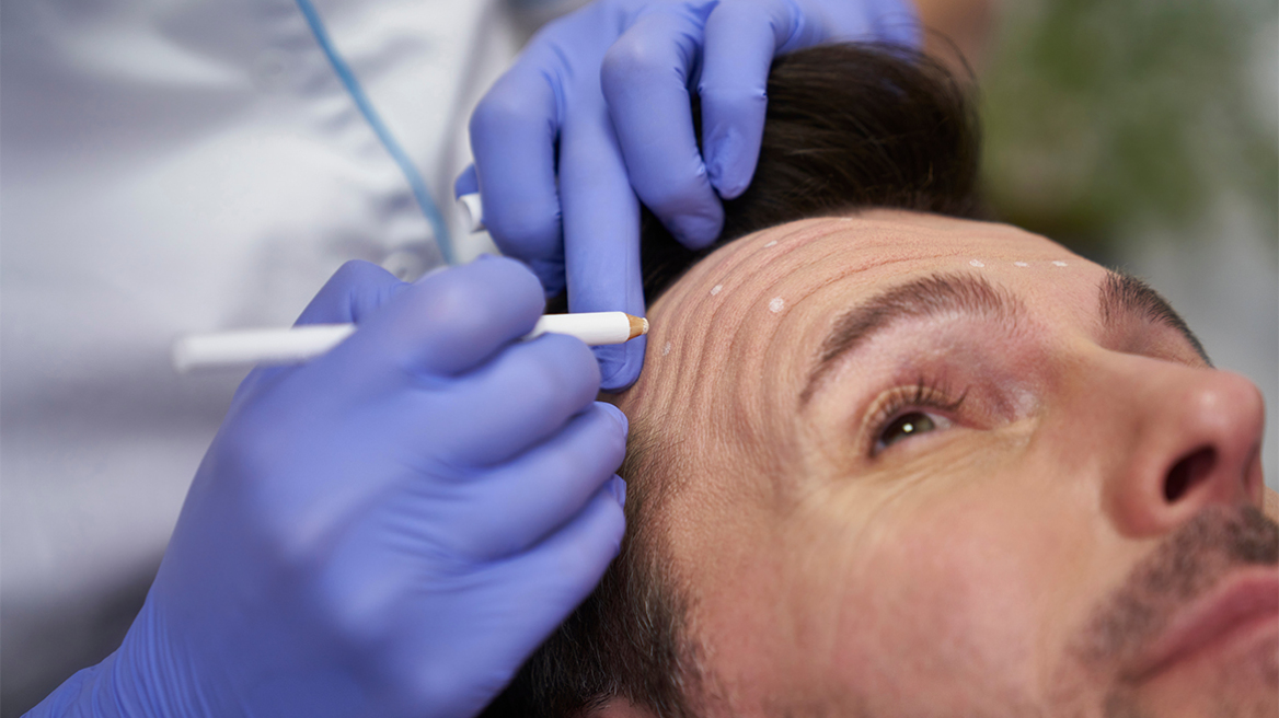 Η μεγάλη άνθιση του botox στους άνδρες