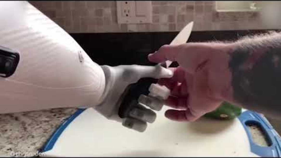 Η ζωή με προσθετικό χέρι είναι πολύ δύσκολη