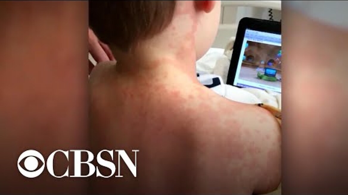 More children diagnosed with illness possibly linked to the coronavirus