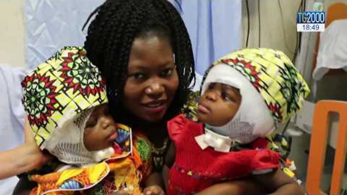 Bambino Gesù, separate gemelle siamesi unite per la testa