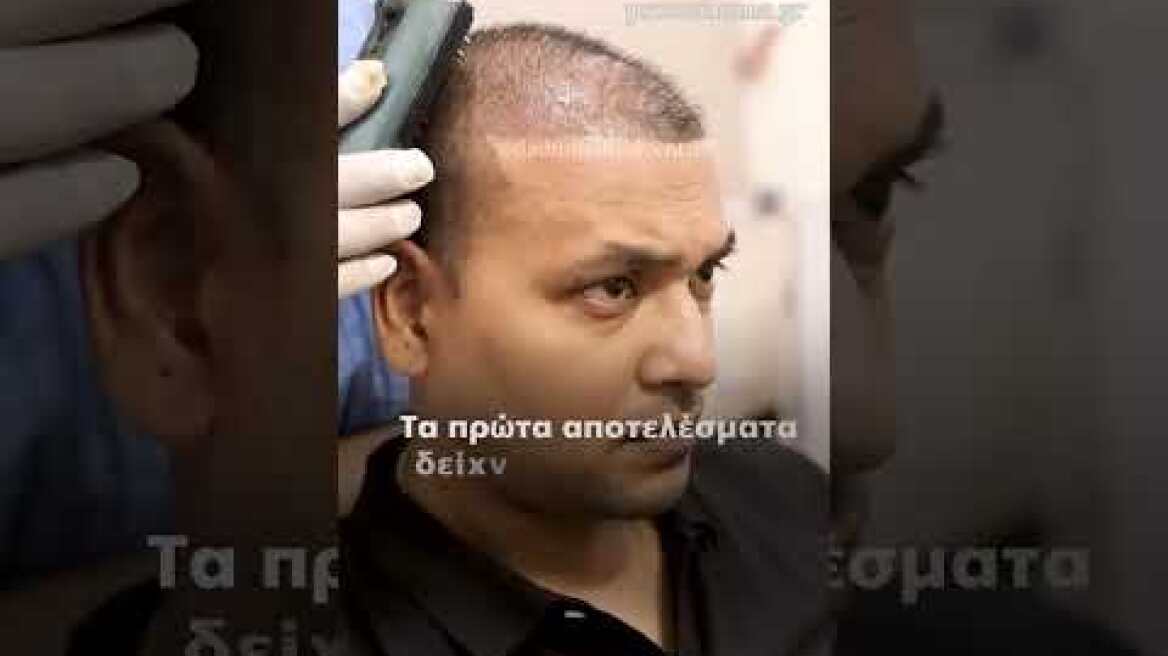 Τέλος η φαλάκρα; Νέος φυτικός ορός συνδέεται με επανεμφάνιση μαλλιών μέσα σε λίγες εβδομάδες