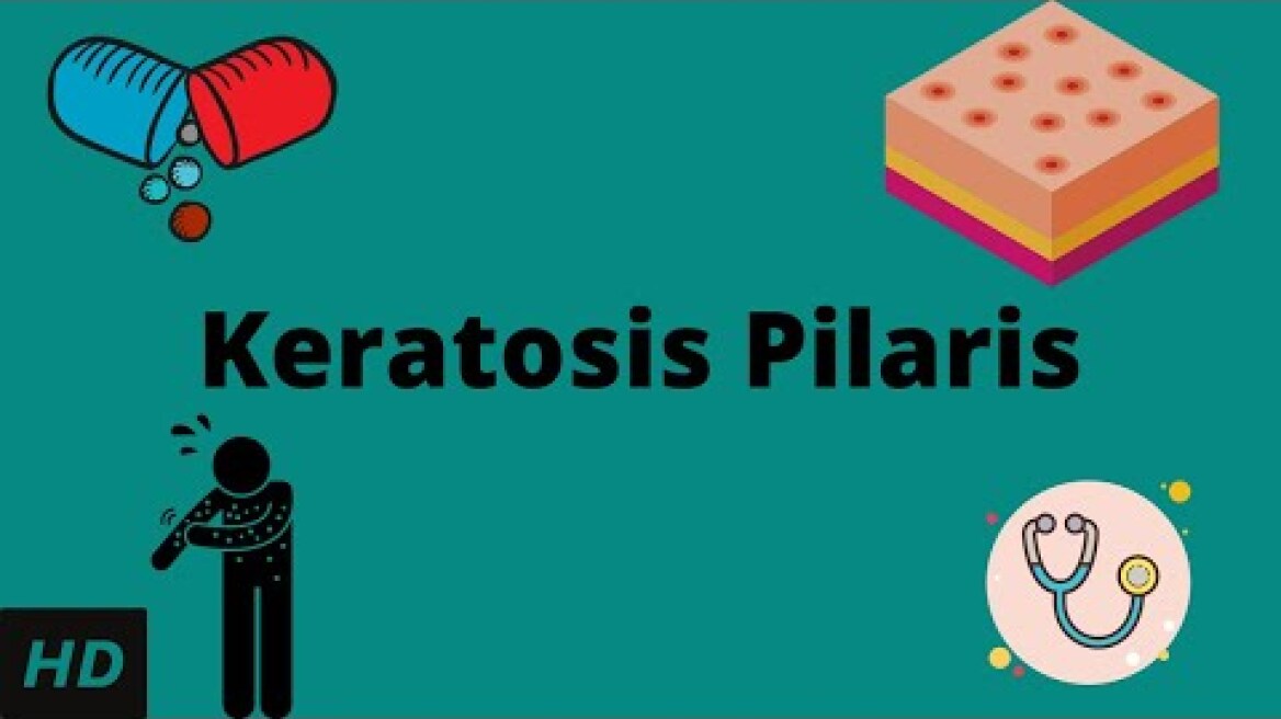 Keratosis Pilaris, Causes, Signs and Symptoms, Diagnosis and Treatment.