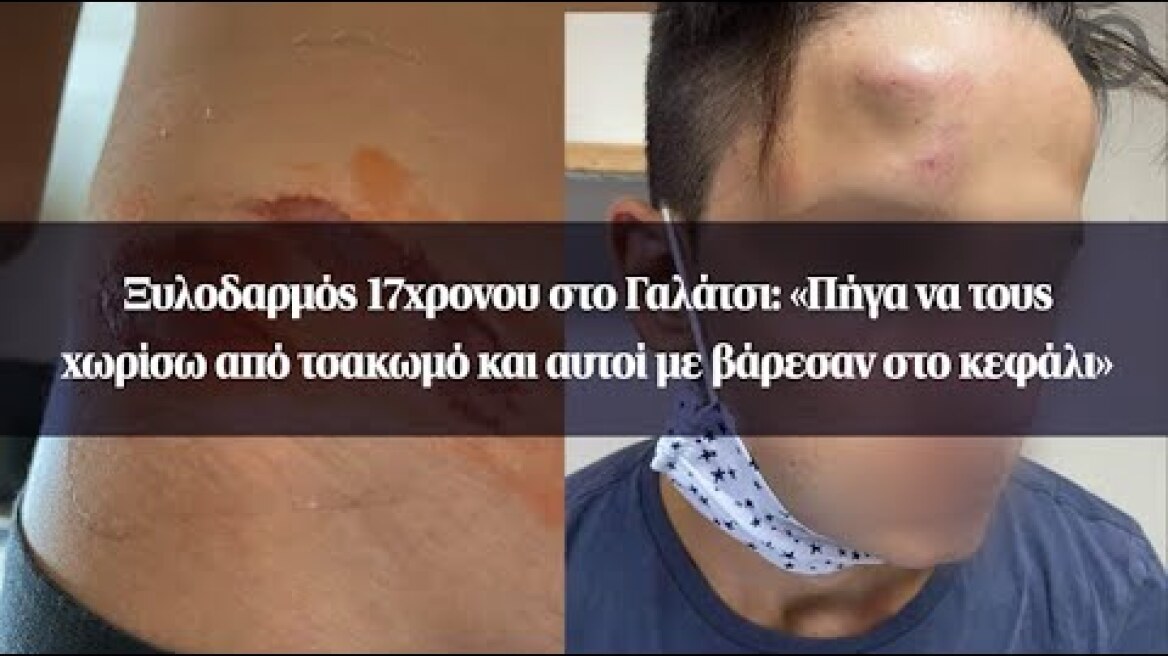Ξυλοδαρμός 17χρονου στο Γαλάτσι: «Πήγα να τους χωρίσω από τσακωμό και αυτοί με βάρεσαν στο κεφάλι»
