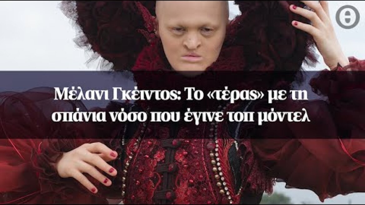 Μέλανι Γκέιντος: Το «τέρας» με τη σπάνια νόσο που έγινε τοπ μόντελ