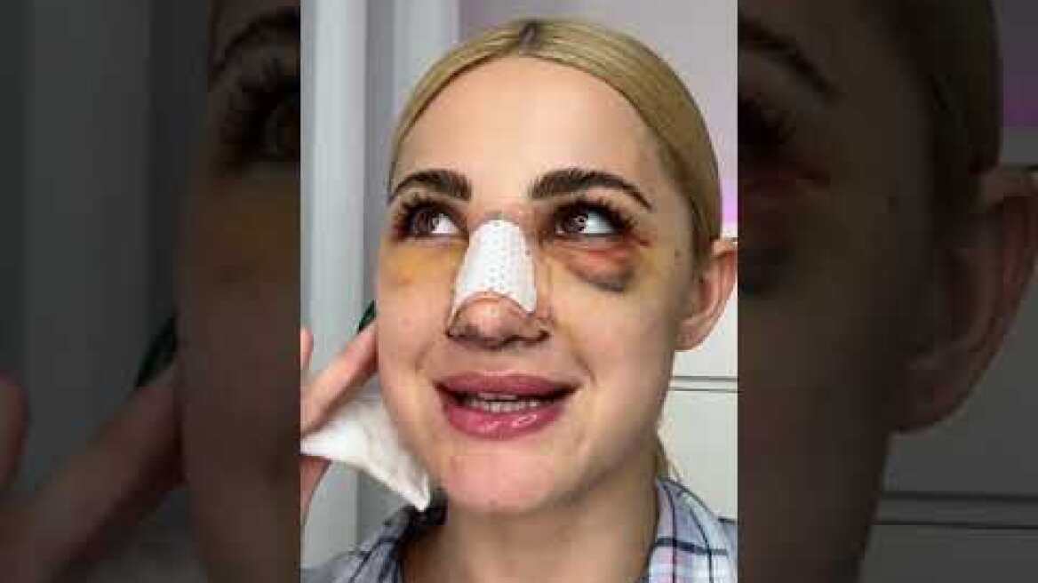 Ιωάννα Τούνη: Πήρα χόνδρο από το πλευρό μου για να φτιάξω τη μύτη μου