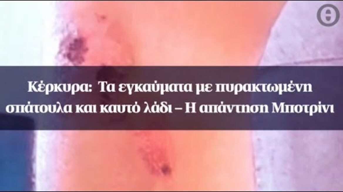 Κέρκυρα:  Τα εγκαύματα με πυρακτωμένη σπάτουλα και καυτό λάδι – Η απάντηση Μποτρίνι