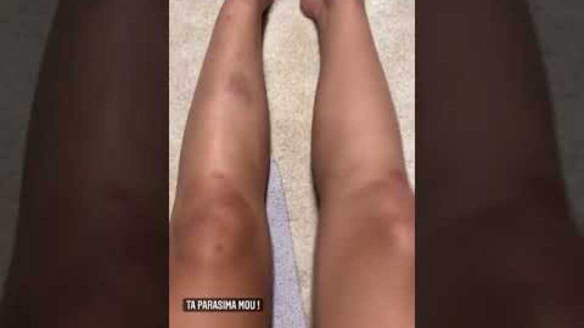 Μελανιασμένη η Φουρέιρα