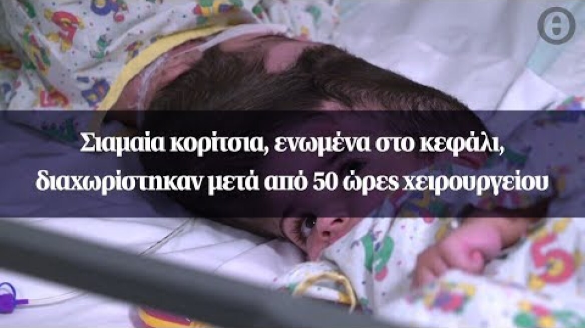 Σιαμαία κορίτσια, ενωμένα στο κεφάλι, διαχωρίστηκαν μετά από 50 ώρες χειρουργείου