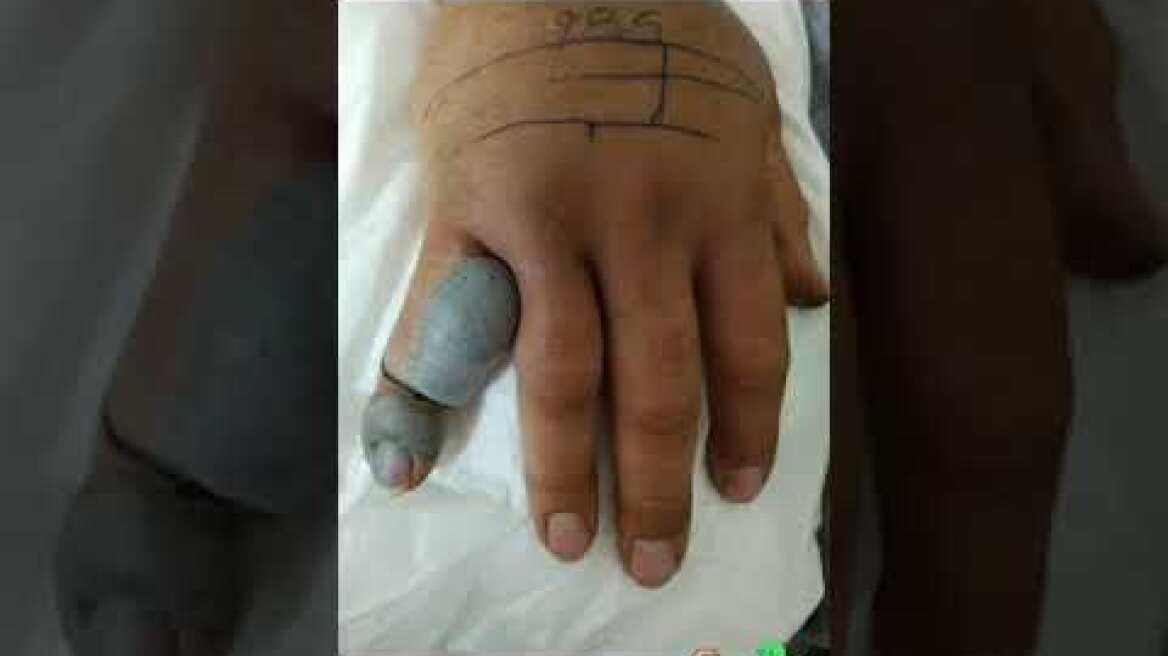 ΓΟΝΝΟΙ ΛΑΡΙΣΑΣ ΔΑΓΚΩΜΑ-ΤΣΙΜΠΗΜΑ, ΔΗΛΗΤΗΡΙΟ ΦΙΔΙΟΥ (ΟΧΙΑΣ) 5/5/2020 (ψηλός), GONNOI, SNAKE