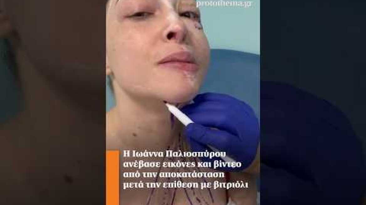 Η Ιωάννα Παλιοσπύρου ανέβασε εικόνες και βίντεο από την αποκατάσταση μετά την επίθεση με βιτριόλι