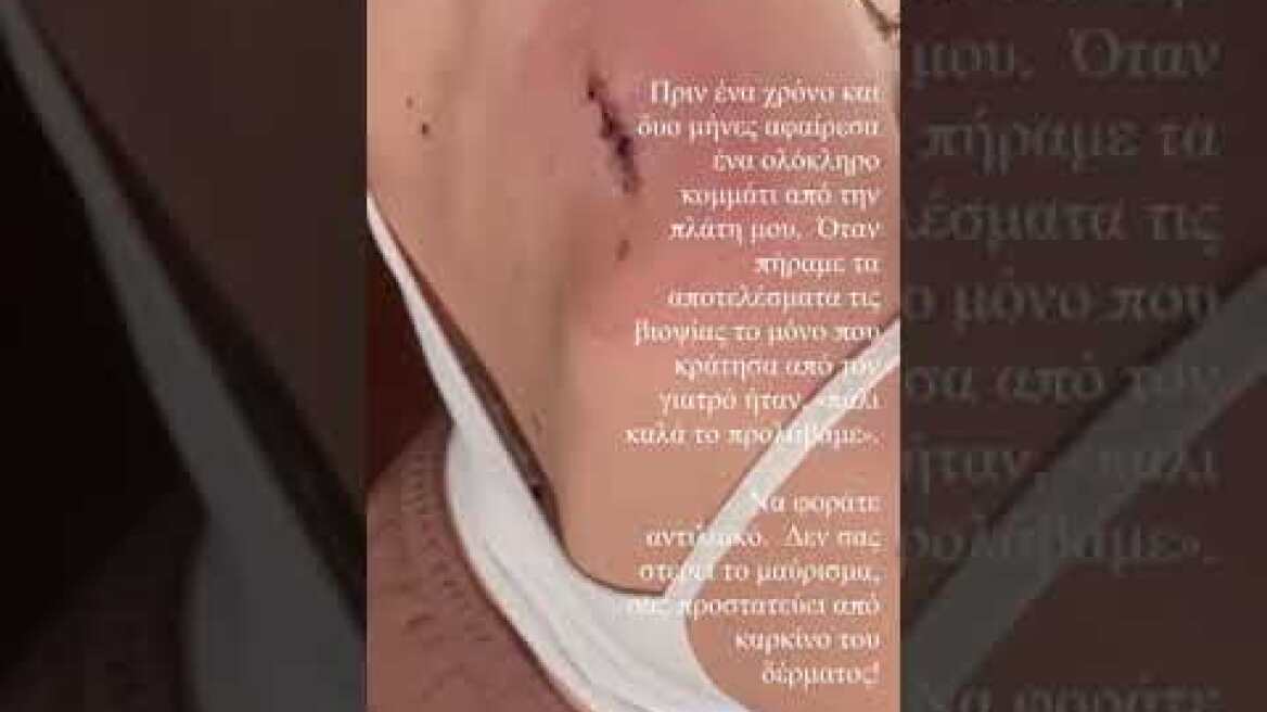 Πρώην παίκτρια του GNTM υποβλήθηκε σε επέμβαση αφαίρεσης όγκου