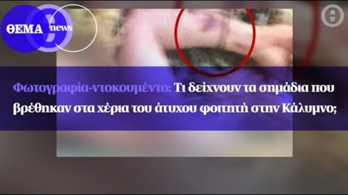 Φωτογραφία: Τι δείχνουν τα σημάδια που βρέθηκαν στα χέρια του άτυχου φοιτητή στην Κάλυμνο;