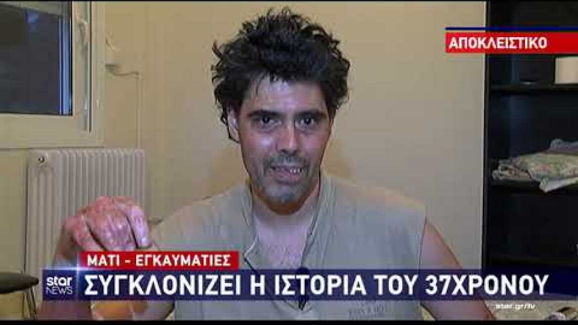 Εγκαυματίας