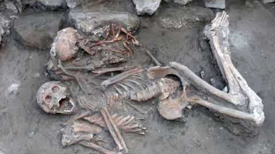 Brain surgery was performed on the skull of a man found 3,400 years ago