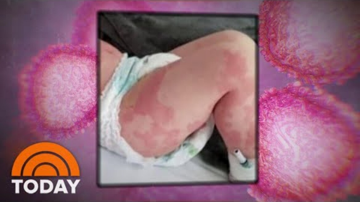 New Cases Of Mystery Children’s Illness Tied To Coronavirus Raise Alarms | TODAY