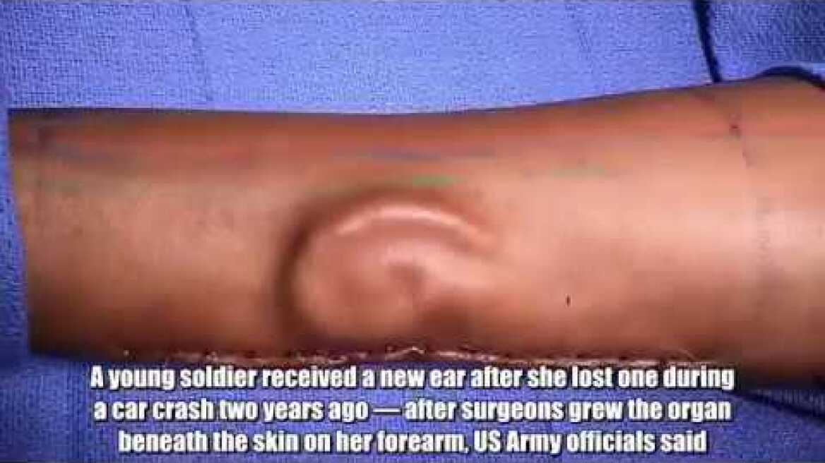 Doctors give soldier New Ear after growing it in her arm