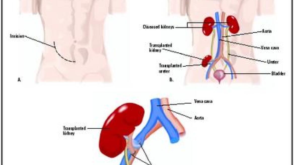 Ελπίδες για νέες θεραπείες στις παθήσεις των νεφρών 