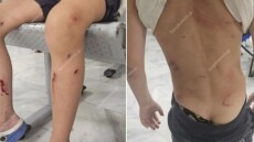 Βόλος: Από θαύμα γλίτωσε 7χρονος όταν του επιτέθηκαν αδέσποτα σκυλιά - Παραλίγο να το κατασπαράξουν, λέει η μητέρα του