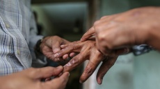 Πουρνάρας: Υπάρχουν σπάνια κρούσματα λέπρας, αλλά δεν εμπνέουν ανησυχία